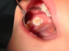 六才臼歯・予防のポイント